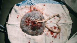 is your placenta showing signs of aging