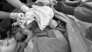 caesarean birth